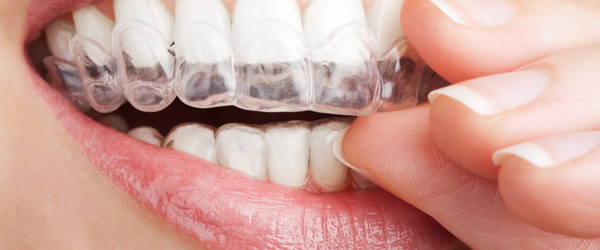 Everything You Need to Know About Whitening Strips