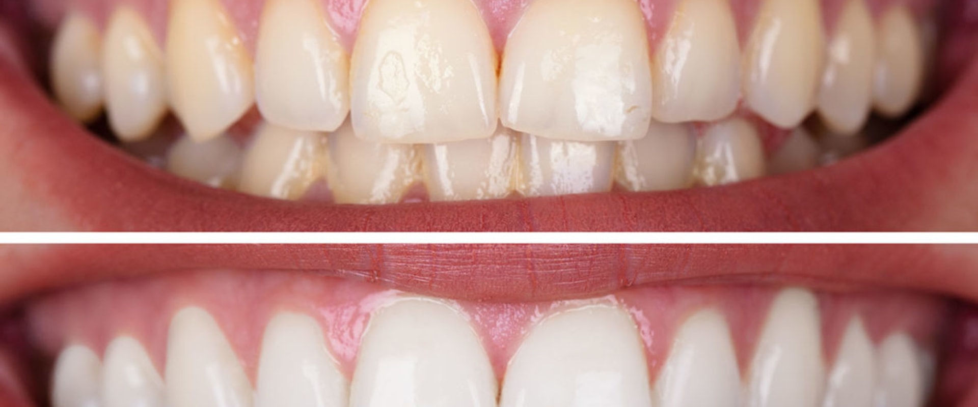 Cost of Whitening Gels and Trays