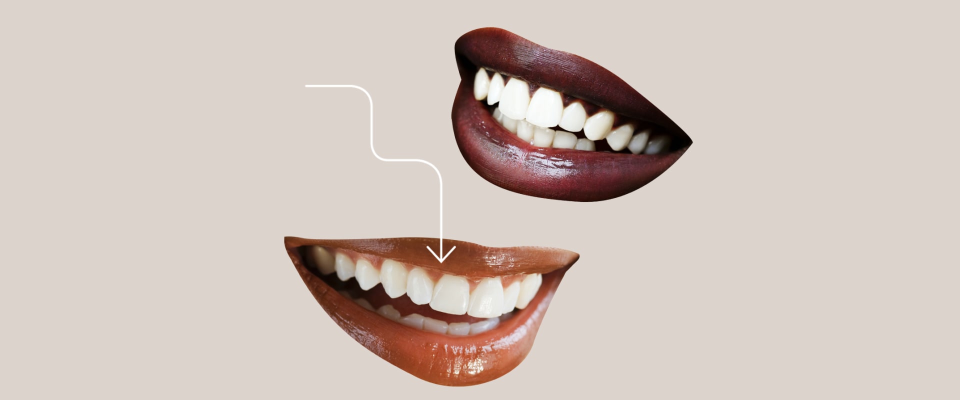Veneers Cost Breakdowns: An Overview of Alternatives to Professional Teeth Whitening Treatments