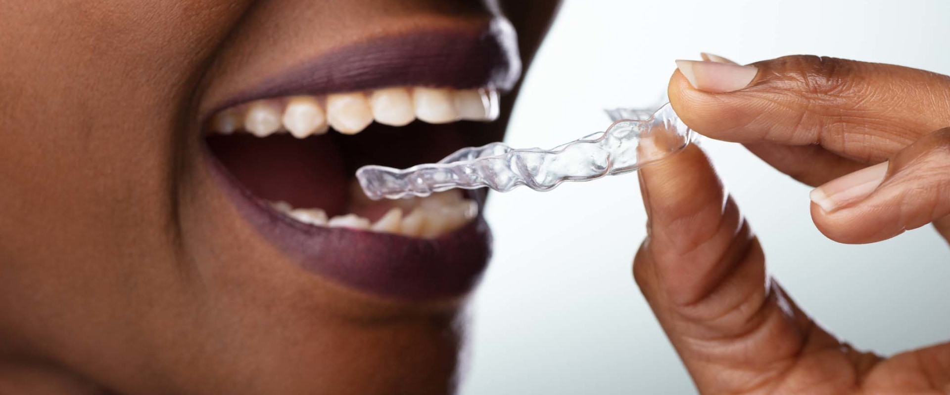 The Cost of At-Home Teeth Whitening Kits