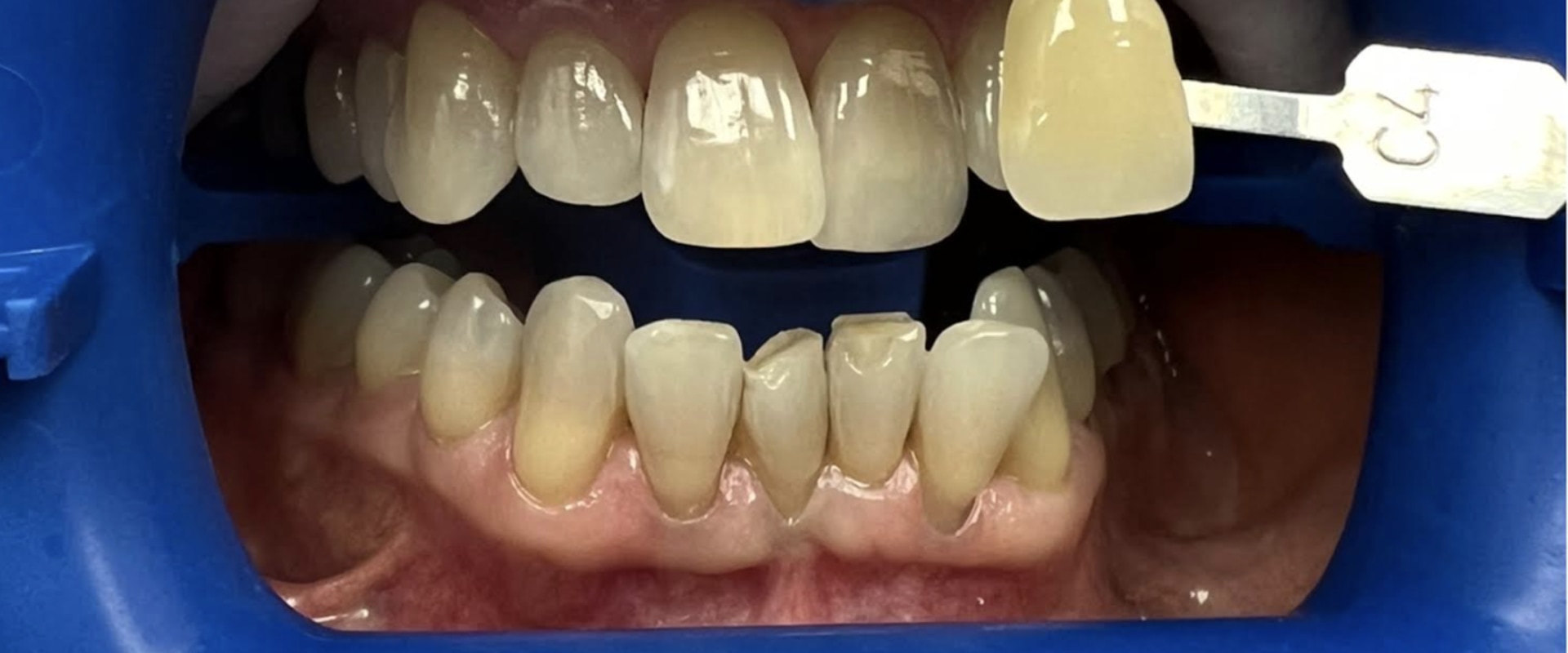 Laser Teeth Whitening: A Comprehensive Overview