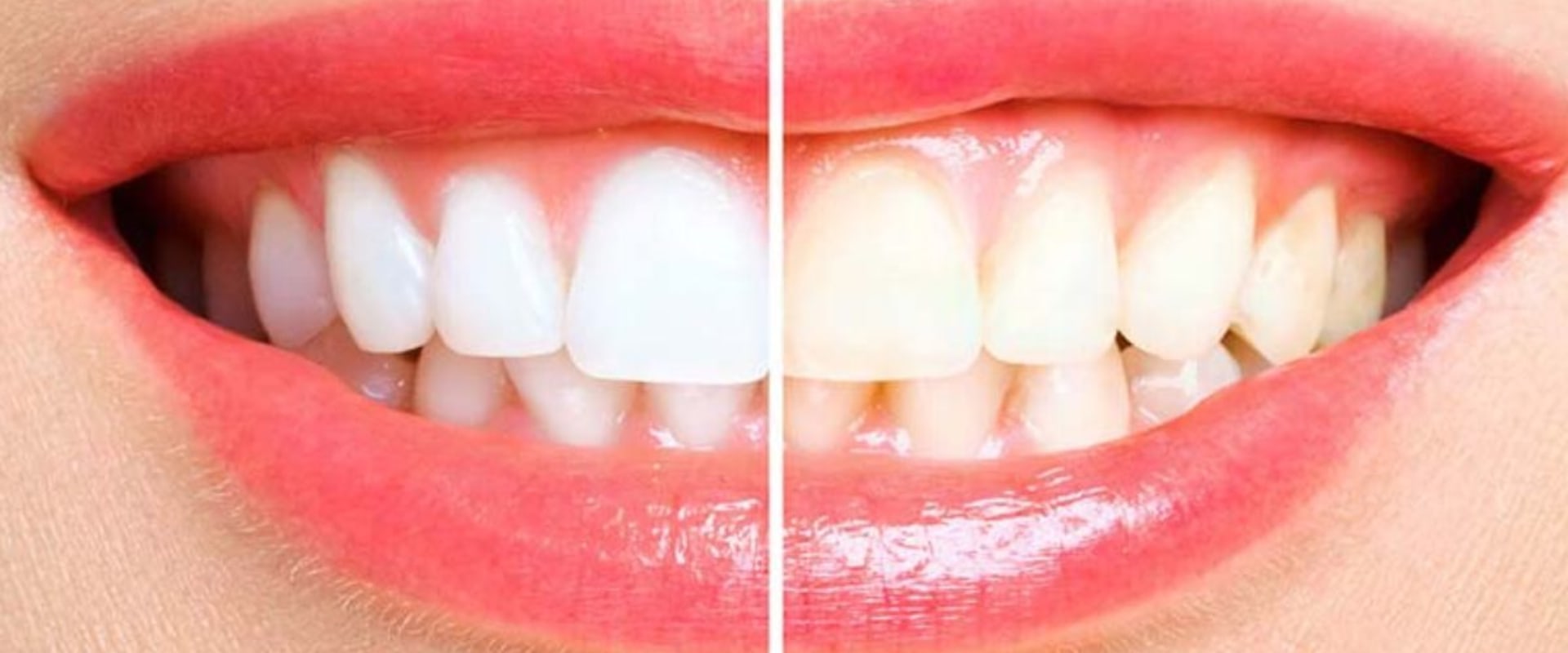 Reviews of Toothpastes and Rinses for At-Home Teeth Whitening Treatments
