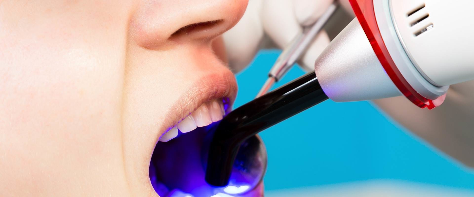 Dental Bonding: A Comprehensive Overview
