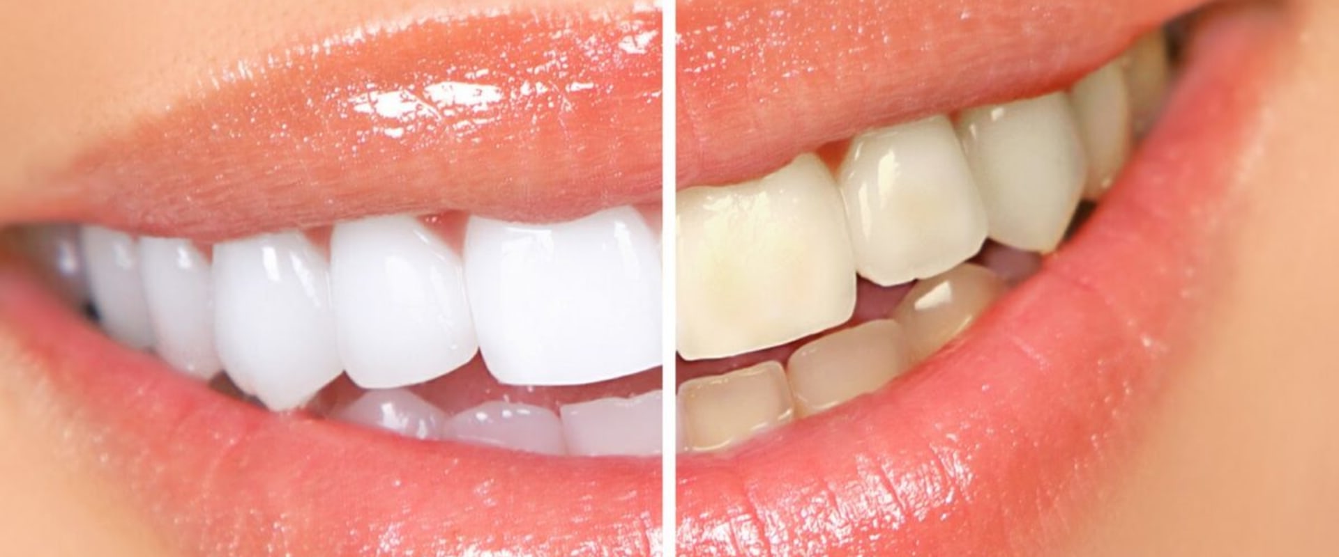 The Cost of Whitening Toothpastes: An Overview