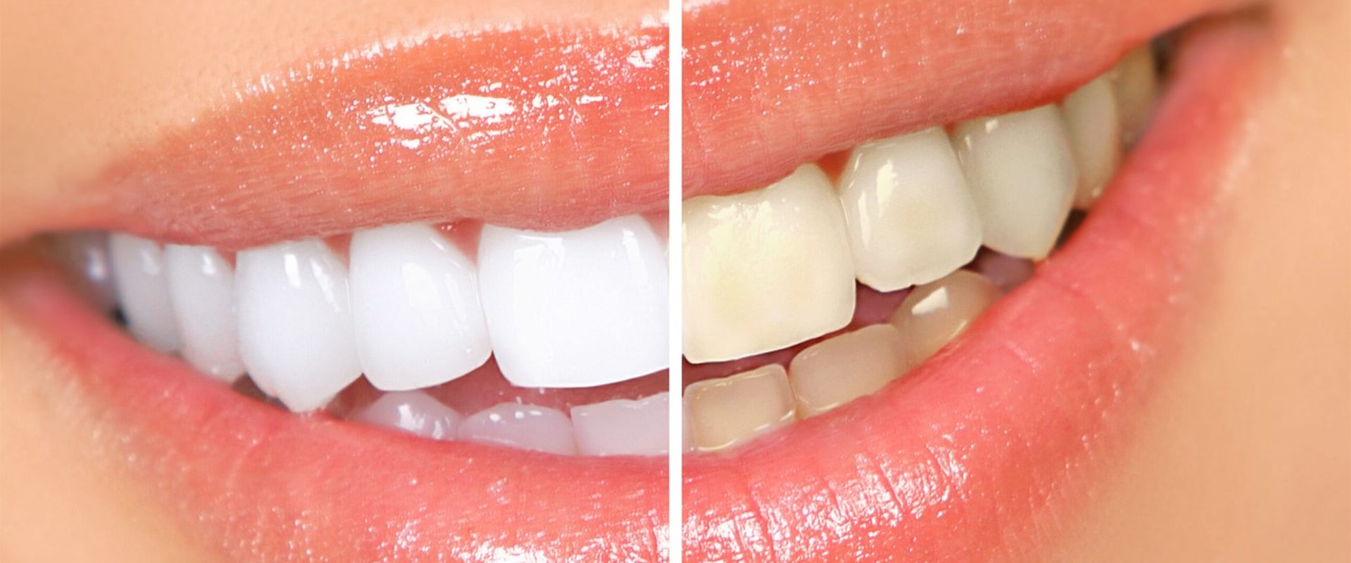 Pros and Cons of Whitening Toothpastes