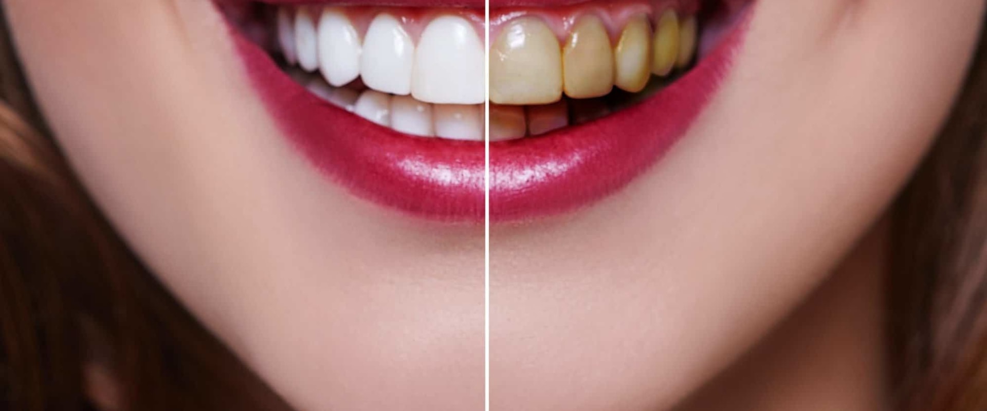 Zoom Whitening Results - What to Expect