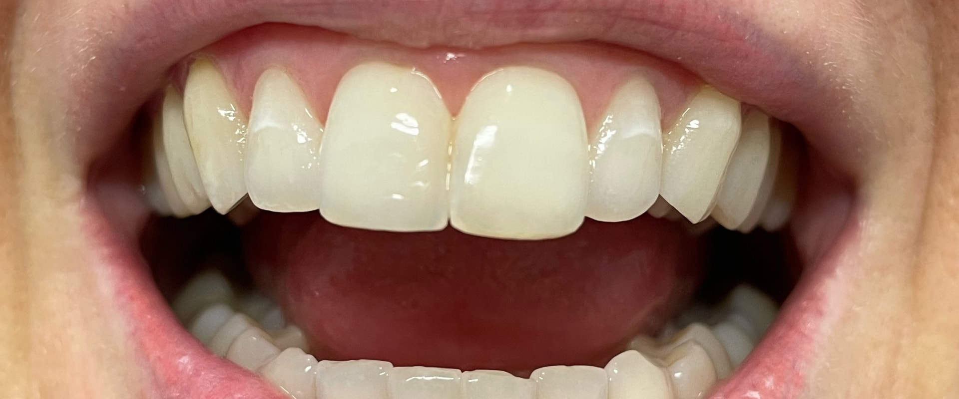 A Comprehensive Look at Enamel Reshaping Results