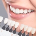 Kor Whitening Reviews: An In-Depth Look at Teeth Whitening Treatments