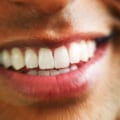 Take-home Kits: All You Need to Know About At-Home Teeth Whitening Treatments