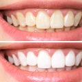 Teeth Whitening Results: Strips and Gels