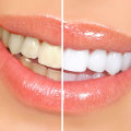 Tips for Using Whitening Toothpastes