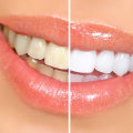 Zoom Whitening: A Comprehensive Overview