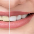 Eating Habits for Whiter Teeth