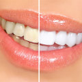 At-Home Teeth Whitening Kits: Pros and Cons