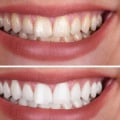 Laser Teeth Whitening Cost Breakdowns