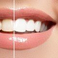 Veneers Results: What to Expect From Teeth Whitening Alternatives