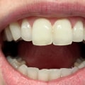 Enamel Reshaping: What to Know About the Teeth Whitening Alternative