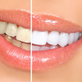Kor Whitening Results: An Overview
