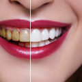 Whitening Gels and Trays: What to Expect
