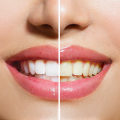 Teeth Whitening Cost: Toothpaste & Rinses Cost Breakdowns