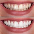The Cost of Professional In-Office Teeth Whitening Treatments
