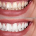 Pros and Cons of In-Office Teeth Whitening