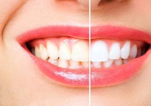 Lemon Juice and Salt Scrub: An At-Home Teeth Whitening Treatment