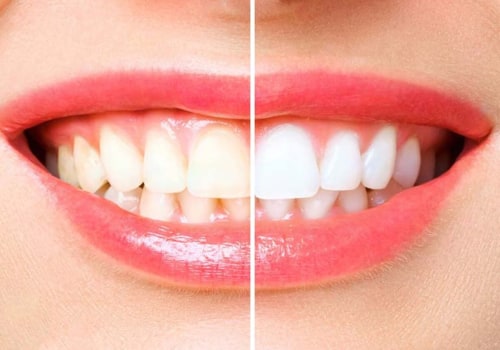Baking Soda and Hydrogen Peroxide Paste: Teeth Whitening Tips and At-Home Remedies