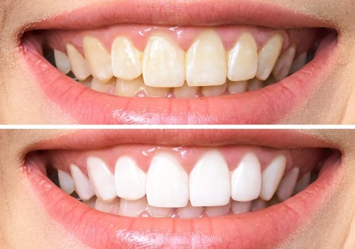 Teeth Whitening Results: Strips and Gels