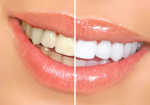 Tips for Using Whitening Toothpastes
