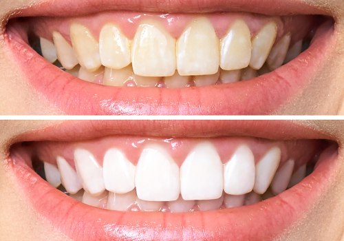 Maintaining Proper Dental Care for Whiter Teeth