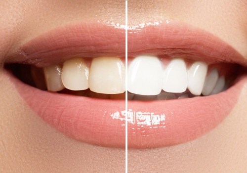 Veneers Results: What to Expect From Teeth Whitening Alternatives