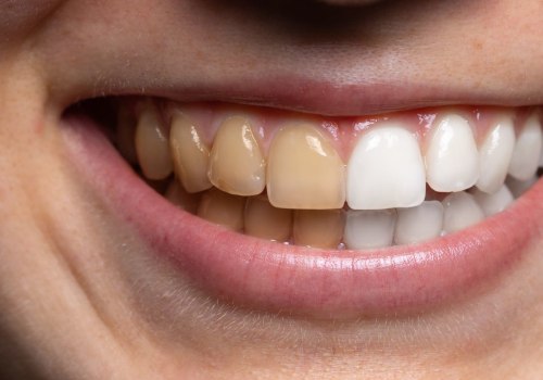 Expected Results from Whitening Toothpastes