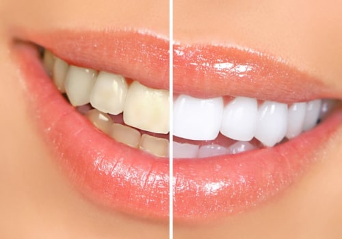 The Cost of Whitening Toothpastes: An Overview