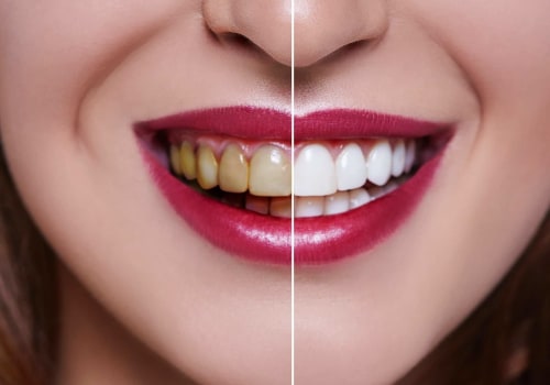 Zoom Whitening Results - What to Expect