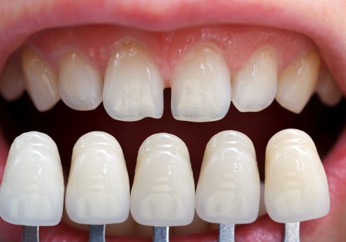 Veneers Reviews: All You Need to Know