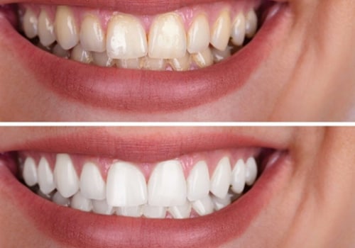 Pros and Cons of In-Office Teeth Whitening
